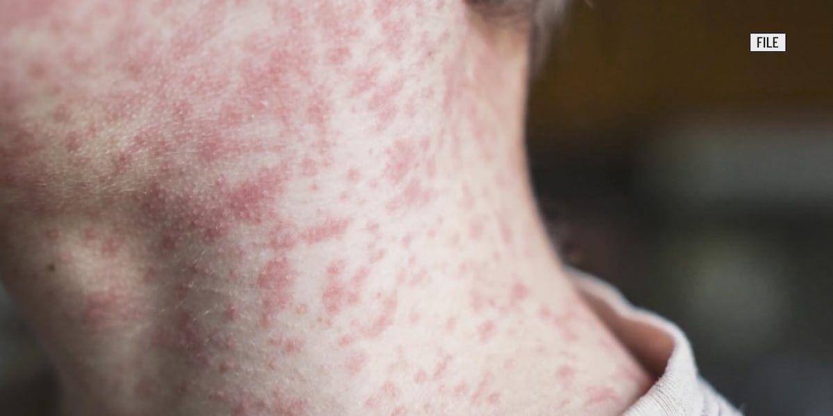 Wood County Health Department confirms measles case; multiple possible exposure sites in Bowling Green