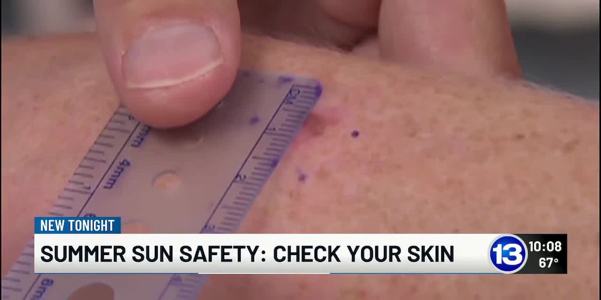 Skin cancer awareness: Doctors urge sun protection as summer begins