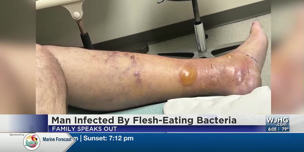 b12 injection flesh eating bacteria Flesh-eating infections are on the rise in the US a microbiologist explains how to protect yourself Florida Man Infected With Flesh-Eating